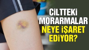 Ciltteki morarmalar tehlikeli olabilir!