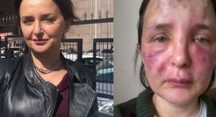 Bakırköy'de kadını dolgu yaparak tanınmaz hale getiren sahte doktora 3 yıl 4 ay ceza