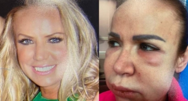 Estetik faciası! Yüzü tanınmaz hale geldi